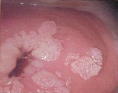 Microcondilomi del collo uterino
